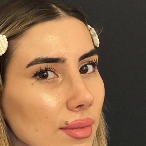 Ultrasound Rhinoplasty Before / After photo